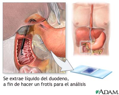 Frotis del tejido duodenal Frotis del tejido duodenal