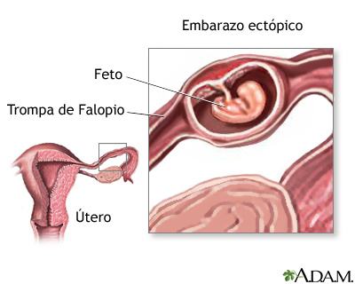 Embarazo ectópico Embarazo ectópico