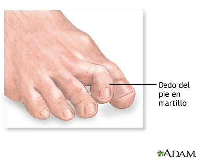 Dedo de pie en martillo Dedo de pie en martillo