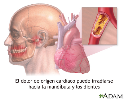 Dolor de mandíbula y ataques cardíacos Dolor de mandíbula y ataques cardíacos