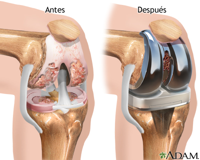 Prótesis de reemplazo de la articulación de la rodilla Prótesis de reemplazo de la articulación de la rodilla