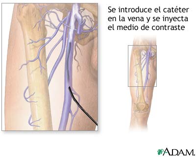 Venografía de la pierna Venografía de la pierna