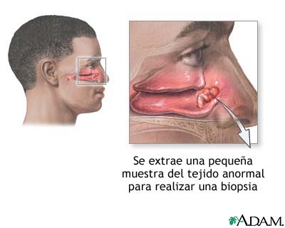 Biopsia nasal Biopsia nasal