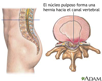 Núcleo pulposo herniado Núcleo pulposo herniado