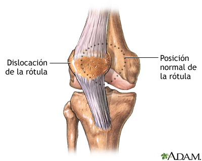 Dislocación de la rótula Dislocación de la rótula