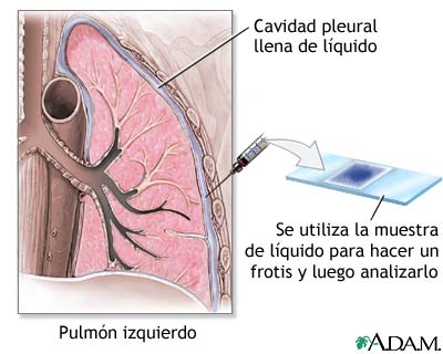 Frotis de pleura Frotis de pleura