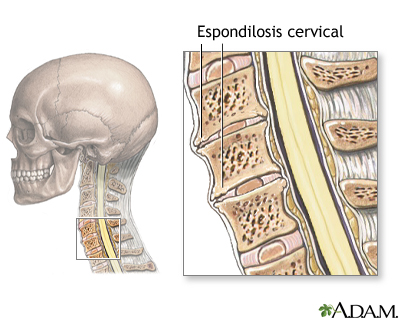 Espondilosis cervical Espondilosis cervical