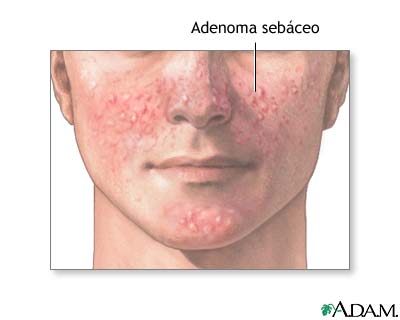 Adenoma sebáceo Adenoma sebáceo