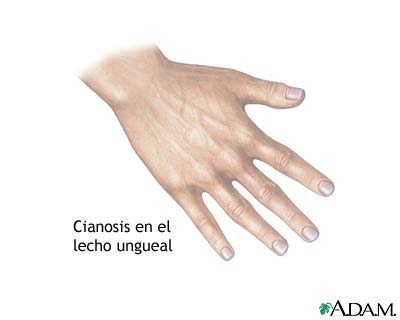 Cianosis del lecho de la uña Cianosis del lecho de la uña
