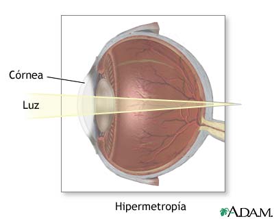 Hipermétrope Hipermétrope