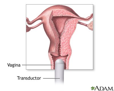 Ultrasonido transvaginal Ultrasonido transvaginal