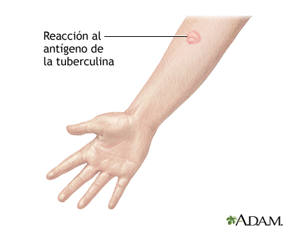 Prueba de la tuberculina Prueba de la tuberculina