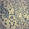 Absceso cerebral amebiano