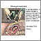 Amniocentesis