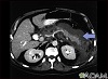 Pancreatitis, aguda - TC