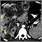 Cáncer hepatocelular - TC