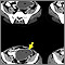Absceso intraabdominal - TC