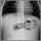 Radiografía de una invaginación