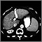 Cirrosis hepatica - TC