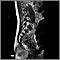 Teratoma - IRM