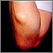 Lipoma en el brazo
