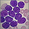 Microfotografía de leucemia linfocítica aguda