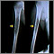Rayos X - un sarcoma de Ewing