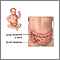 Obstrucción intestinal (pediátrico) - serie