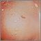 Impetigo - ampollas en las nalgas