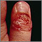 Panadizo herpético del pulgar
