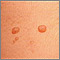 Molusco contagioso - primer plano
