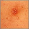 Molusco contagioso - primer plano del tórax