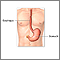 Colocación de un tubo de gastrostomía - serie