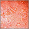 Acercamiento de lesiones por dermatitis herpetiforme
