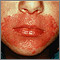 Candidiasis, cutánea - alrededor de la boca