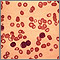 Leucemia linfocítica crónica - vista microscópica