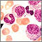 Vista microscópica - leucemia mielocítica crónica