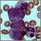 Leucemia mielocítica crónica