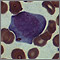 Mononucleosis - microfotografía de células