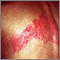 Herpes zoster (culebrilla) en la espalda