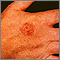 Enfermedad de Bowen de la mano