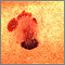 Cáncer de piel - melanoma maligno