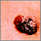 Cáncer de piel - melanoma multicolor en relieve