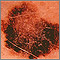 Cáncer de piel, melanoma - lesión superficial parda