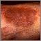 Liquen simple y crónico del tobillo