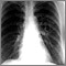 Coccidioidomicosis - radiografía de tórax