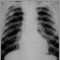 Neumoconiosis del minero - etapa II