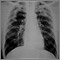 Neumoconiosis complicada del minero