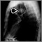 Masa pulmonar - Vista lateral de la radiografía de tórax