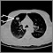 Masa pulmonar, lóbulo superior derecho - Tomografía computarizada